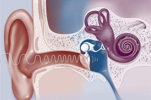 人工耳蝸 人工耳蝸